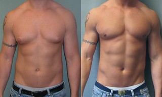 Photo of Get back in shape with  Vaser  Liposuction